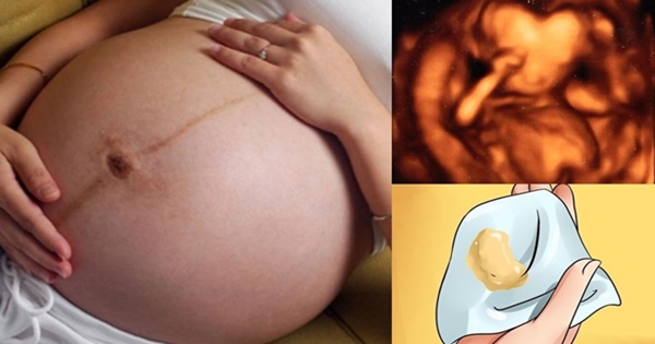 Khi mắc phải bệnh viêm âm đạo do lậu cầu khuẩn trong quá trình mang thai, mẹ bầu thường sẽ có các triệu chứng như tiểu đau buốt